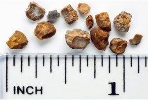 how to dissolve kidney stones
