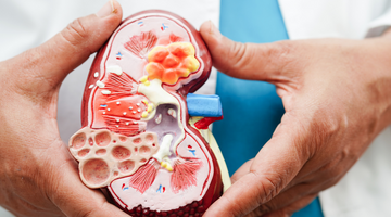 Passing A Kidney Stone: Stages