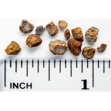 The 4 Main Types of Kidney Stones Explained