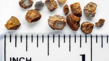 The 4 Main Types of Kidney Stones Explained